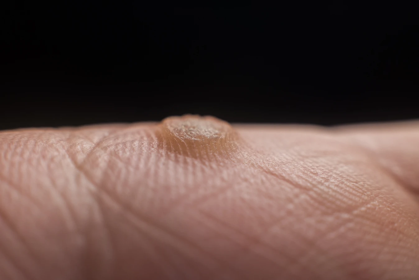 Co dobre na kurzajki?